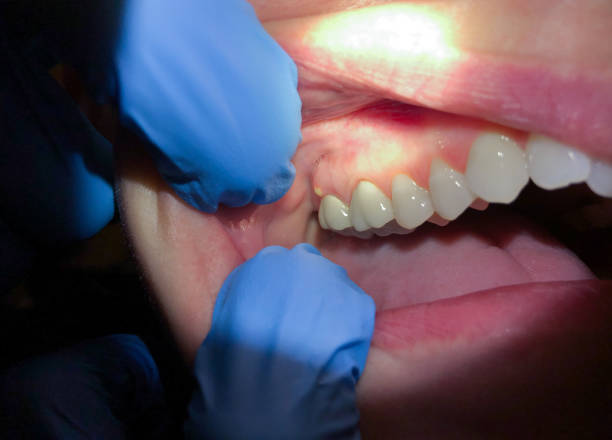 Best Broken Tooth Emergency  in Clarcona, FL